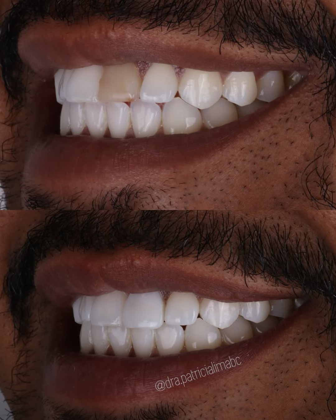Antes e Depois 2